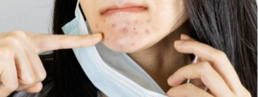 Do Surgical Mask Cause Acne?